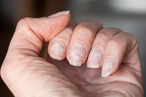 hypothyroid fingernails