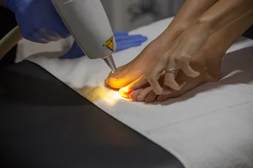 laser treatment for nail fungus