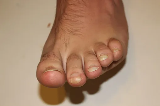 what does toe nail fungus look like