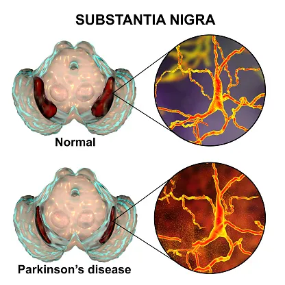 alzheimers and parkinsons