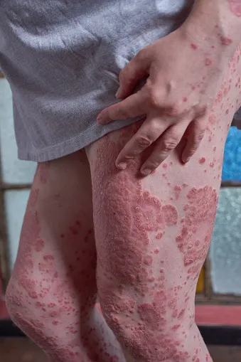 what is the difference between eczema and psoriasis