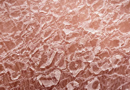 what's the difference between eczema and psoriasis